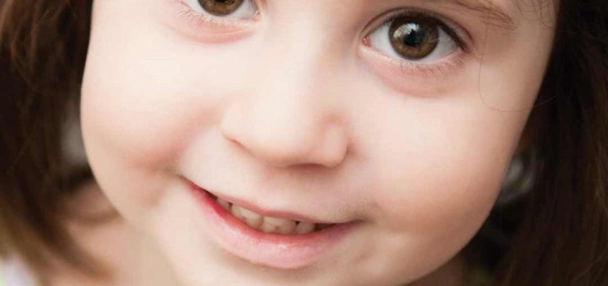 Condizioni della sindrome di Rett